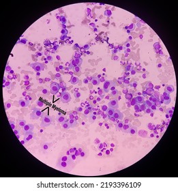 Microscopic Image Of Bone Marrow. Plasma Cell Dyscrasia Or Multiple Myeloma. A Type Of Bone Marrow Cancer Of Malignant Plasma Cells.