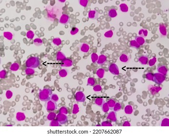 Microscopic Image Of Bone Marrow. Plasma Cell Dyscrasia Or Multiple Myeloma. A Type Of Bone Marrow Cancer Of Malignant Plasma Cells.