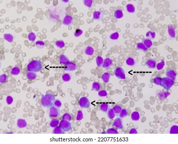 Microscopic Image Of Bone Marrow. Plasma Cell Dyscrasia Or Multiple Myeloma. A Type Of Bone Marrow Cancer Of Malignant Plasma Cells.