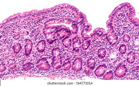 Microscopic Image Of An Endoscopic Biopsy Form A Patient With Bloating And Diarrhea From Celiac Diseae (sprue, Gluten Sensitive Enteropathy, Showing Villous Blunting And Intraepithelial Lymphocytes.