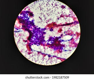 Microscopic Image Of Fine Needle Aspiration (FNA) Cytology Of A Pulmonary (lung) Nodule Showing Adenocarcinoma, A Type Of Non Small Cell Carcinoma.