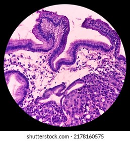 Microscopic Image Of Gastric Carcinoid Tumor, Rare Tumors That Develop Within The Gastric Mucosa. Neuroendocrine Tumor (NET), Which Presented As A Gastric Polyp