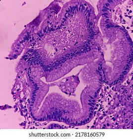 Microscopic Image Of Gastric Carcinoid Tumor, Rare Tumors That Develop Within The Gastric Mucosa. Neuroendocrine Tumor (NET), Which Presented As A Gastric Polyp