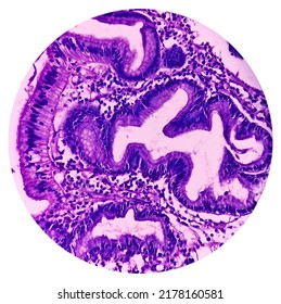 Microscopic Image Of Gastric Carcinoid Tumor, Rare Tumors That Develop Within The Gastric Mucosa. Neuroendocrine Tumor (NET), Which Presented As A Gastric Polyp