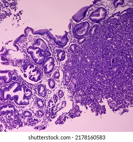 Microscopic Image Of Gastric Carcinoid Tumor, Rare Tumors That Develop Within The Gastric Mucosa. Neuroendocrine Tumor (NET), Which Presented As A Gastric Polyp