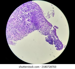 Microscopic Image Of Gastric Carcinoid Tumor, Rare Tumors That Develop Within The Gastric Mucosa. Neuroendocrine Tumor (NET), Which Presented As A Gastric Polyp