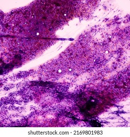 Microscopic image of Lymphoproliferative disorder at cervical lymph node cytology, smear show polymorphous of lymphocytes with histiocytes.