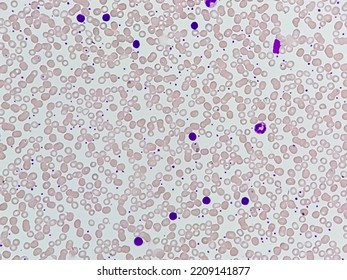 Microscopic Image Of Monocytic Leukocytosis, Increase Total Count Of White Blood Cell And Increase Number Of Monocyte