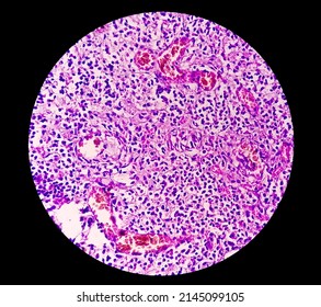 Microscopic Image (photomicrograph) Of A Cross Section Of An Appendix In A Child With Acute Appendicitis.