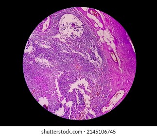 Microscopic Image (photomicrograph) Of A Cross Section Of An Appendix In A Child With Acute Appendicitis.