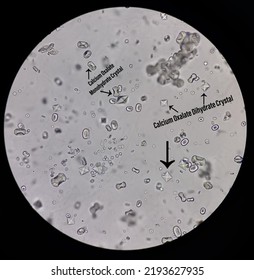 what causes calcium oxalate crystals in urine in dogs