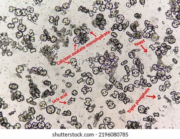 Microscopic Image Showing Calcium Oxalate Monohydrate, Uric Acid Crystals And Triple Phosphate Crystals From Urine Sediment. UTI. Kidney Disease.