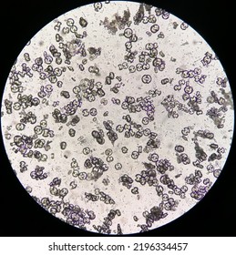 Microscopic Image Showing Calcium Oxalate Monohydrate, Uric Acid Crystals And Triple Phosphate Crystals From Urine Sediment. UTI. Kidney Disease.