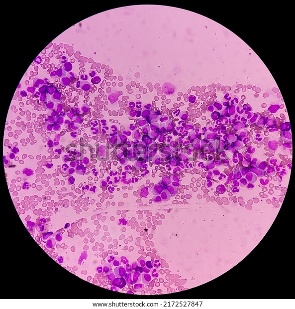 Microscopic image showing Chronic myeloid\
leukaemia (CML) is a type of cancer, all stage of granulocytic\
maturation is noted, CML in chronic\
phase.