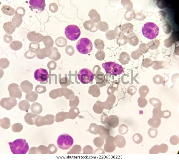 Microscopic image showing Chronic myeloid
leukaemia (CML) is a type of cancer, all stage of granulocytic
maturation is noted, CML in chronic
phase.
