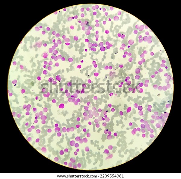 Microscopic image showing Chronic myeloid leukaemia\
(CML) is a type of cancer, all stage of granulocytic maturation is\
noted, CML in chronic\
phase