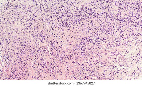 Microscopic image showing histology of a glioblastoma multiforme (GBM), a type of brain cancer.  Necrosis and vascular proliferation are diagnostic features of this high grade malignant tumor. 