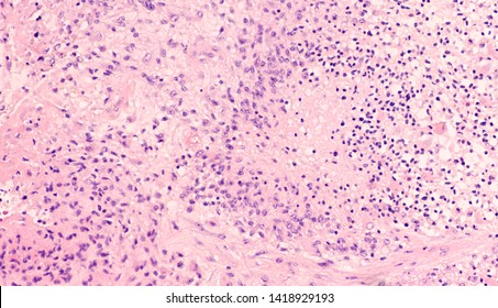 Microscopic image showing histology of a glioblastoma multiforme (GBM), a type of brain cancer.  Necrosis and vascular proliferation are diagnostic features of this high grade malignant tumor. 