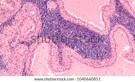 Microscopic image showing histology (pathology) of a Warthin's tumor, a benign tumor of the salivary gland.