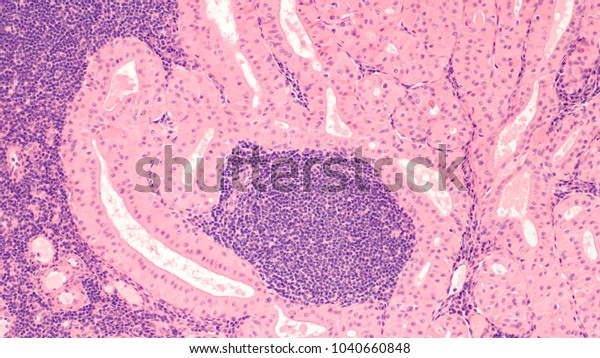 Microscopic Image Showing Histology Pathology Warthins Stock Photo ...