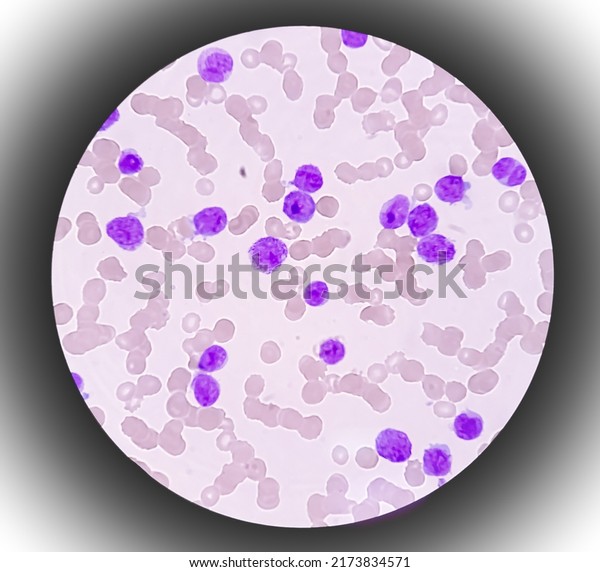 Microscopic image showing thrombocytopenia with\
leukocytosis, monocytes and myelocytes increased,\
myeloproliferative\
disorder.