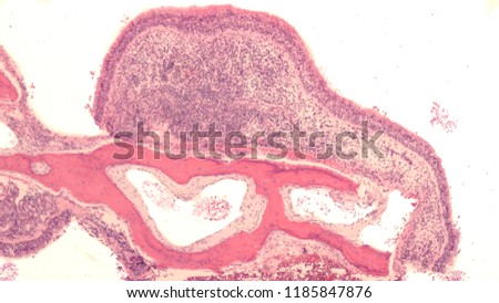Microscopic image of tissue from endoscopic sinus surgery of the paranasal sinuses, including bone and respiratory mucosa with dense submucosal chronic inflammation (lymphocytes and plasma cells).