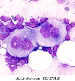 Microscopic Image Of Touch Prep Cytology Smear Of A Lymph Node In A Patient With Hodgkin's Disease (lymphoma), Showing  Reed Sternberg Cells (bi-nucleated Cells With Prominent Nucleoli).