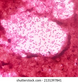 Microscopic image of vertebral lesion cytology, Inflammatory lesion, show polymorphs,lymphocytes,histiocytes,fibrous tissue, blood cell background.