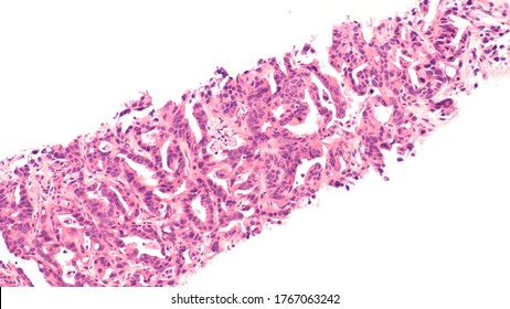 Microscopic Photograph Of A Core Biopsy Of Liver, Showing Histology Of Metastatic  Pancreatic Adenocarcinoma (cancer Of Pancreas). 
