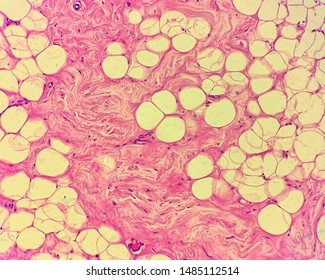 Microscopic picture of breast; fibrous stroma and adipose tissue
