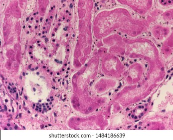 Microscopic Picture Of Kidney Disease, The History Of Acute Kidney Injury