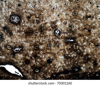 Microscopic Section X100 Of Normal Hard (compact) Bone Showing Details Of Haversian Canals, Lamellae And Osteoblasts.