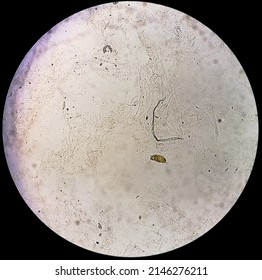 Microscopic urinalysis showing Granular cast in urine sediment.