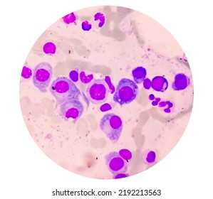 Microscopic View Of Bone Marrow Slide Feature Are Suggestive Multiple Myeloma, Also Known As Myeloma, Is A Type Of Bone Marrow Cancer.