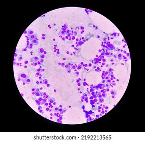 Microscopic View Of Bone Marrow Slide Showing Multiple Myeloma, Also Known As Myeloma, Is A Type Of Bone Marrow Cancer.