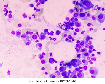 Microscopic View Of Bone Marrow Slide Showing Multiple Myeloma, Also Known As Myeloma, Is A Type Of Bone Marrow Cancer.