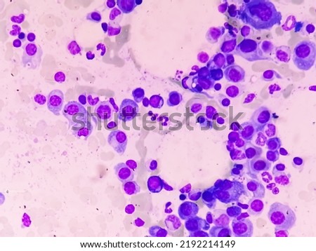 Microscopic view of bone marrow slide showing Multiple myeloma, also known as myeloma, is a type of bone marrow cancer.