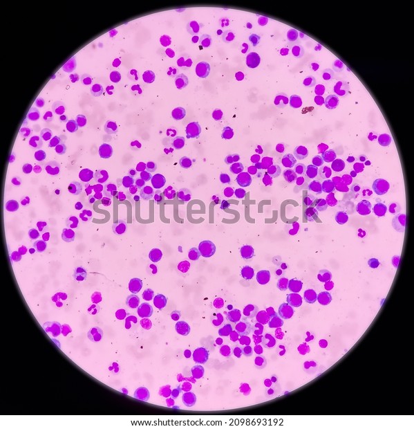 Microscopic View Bone Marrow Slide Megaloblastic Stock Photo 2098693192 ...