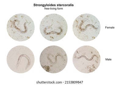 Microscopic view collage of free-living form male and female Strongyloides stercoralis in human stool, a pathogenic parasitic threadworm causing the disease strongyloidiasis.