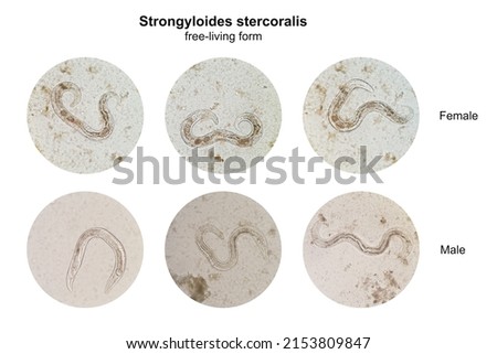 Microscopic view collage of free-living form male and female Strongyloides stercoralis in human stool, a pathogenic parasitic threadworm causing the disease strongyloidiasis.