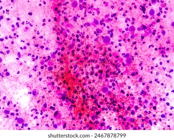 Microscopic view of CT guided fine needle aspiration cytology (FNAC), cellular material composed of monotonous population of adenocarcinoma,malignancy. 40x view