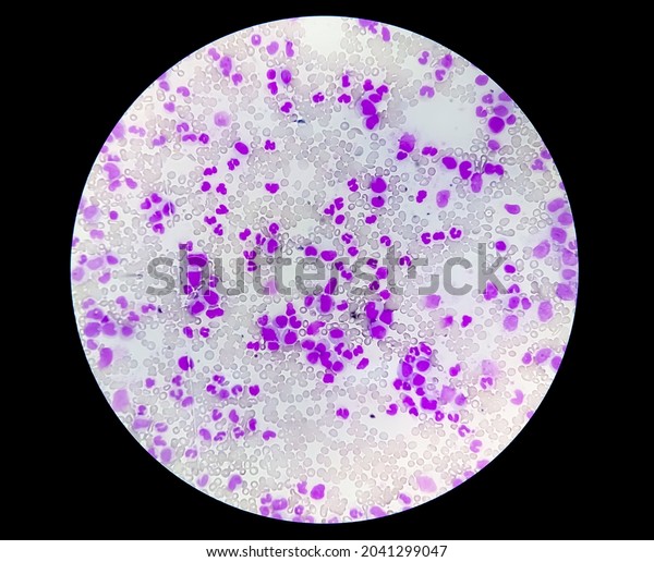 Microscopic View Hematological Stained Slide Thrombocytopenia Stock ...