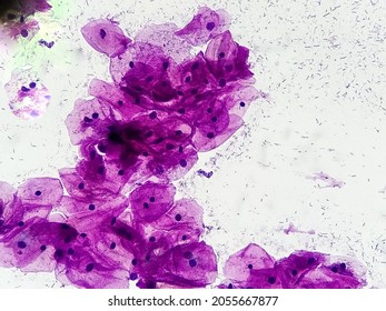 Microscopic view of human cervix cells. Squamous epithelial cells. Pap smear. pap's. Squamous cell carcinoma (SCC)