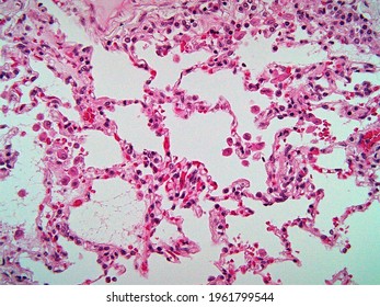 Microscopic view of lung tissue with congestion as shown by the red blood cells in the walls of the alveoli. Pneumonia.