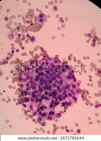 
Microscopic view of metastatic malignant cells in the peritoneal body fluids
