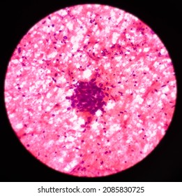 Microscopic View Of Proliferative Breast Disease With Atypia, Show Ductal Epithelial Cells, Background Show Inflammatory Cells And Blood. Atypical Ductal Hyperplasia