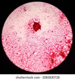 Microscopic View Of Proliferative Breast Disease With Atypia, Show Ductal Epithelial Cells, Background Show Inflammatory Cells And Blood. Atypical Ductal Hyperplasia