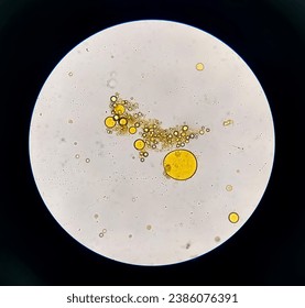 Microscopic view of stool analysis showing Neutral fat. fecal fat globules. Enteric infections, impaired digestion, loss of villous cells and poor fat absorption can lead neutral fat in stool.