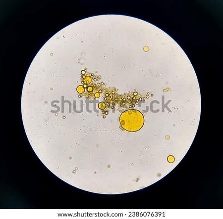 Microscopic view of stool analysis showing Neutral fat. fecal fat globules. Enteric infections, impaired digestion, loss of villous cells and poor fat absorption can lead neutral fat in stool.