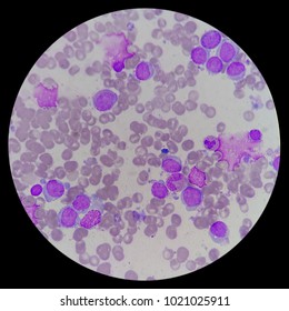 Microscopic Zoom. Bone Marrow Aspiration Smear From Relapsed Acute Myeloid Leukemia (AML) Pediatric Patient. Smear Shows Myeloblast, Platelets, And Erythroblast.